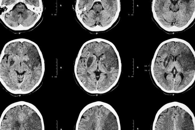 Ovako izgleda mozak osobe obolele od Alchajmerove bolesti / VIDEO